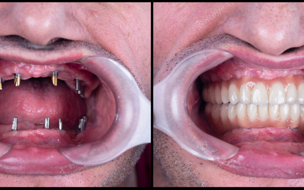 full mought re construction by dental implants and ceramic crown